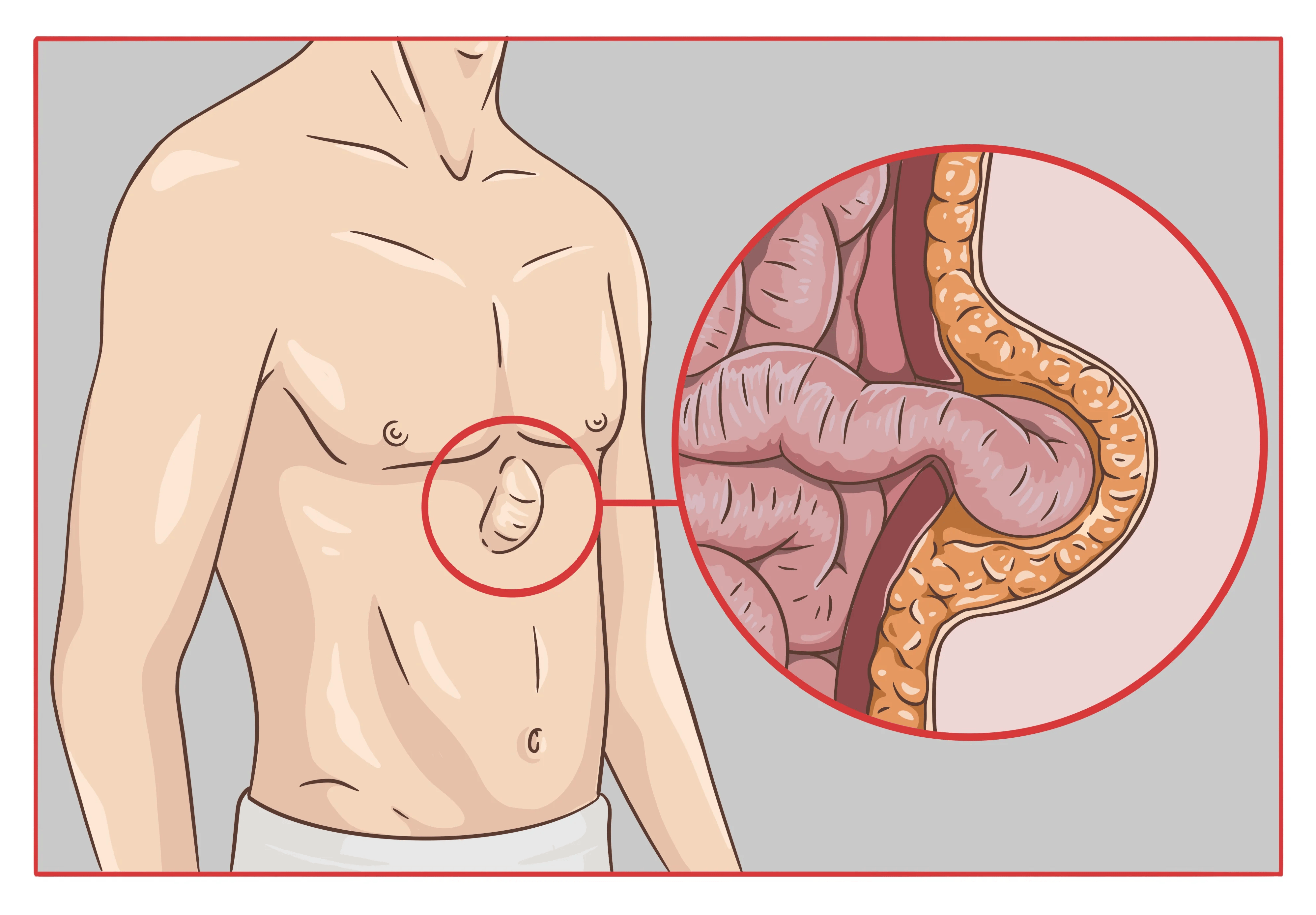 Epigastrische Hernie