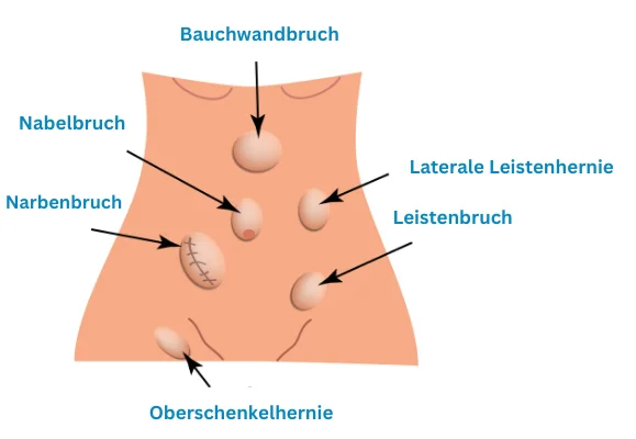 Bauchwandbruch, Nabelbruch, Leistenbruch und Narbenbruch im Vergleich